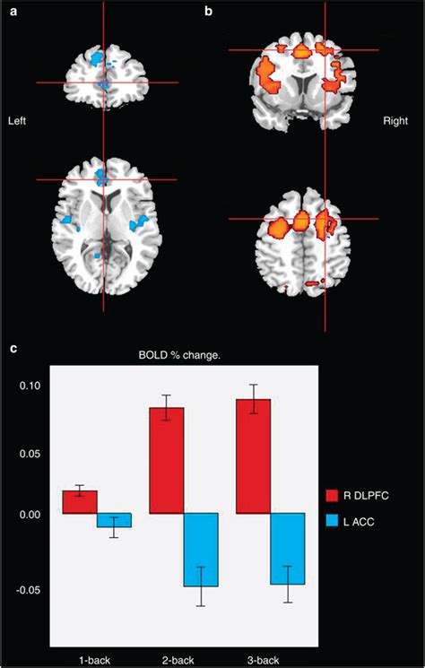 Slices of the brain taken in the coronal plane are similar to the slices from a loaf of bread. Brain maps representing the coronal and axial planes with ...