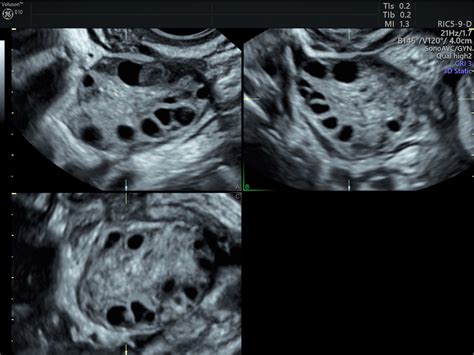 Pcos Diagnosis And The Role Of Pelvic Ultrasound Empowered Womens Health