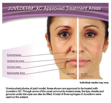 Look Younger Instantly With Juvederm At Skinovative Gilbert Med Spa