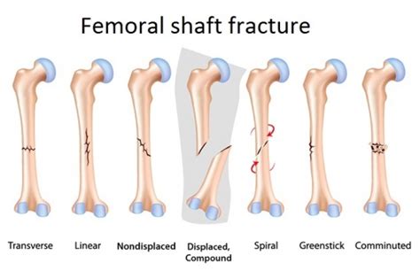 Femoral Fractures Physiopedia