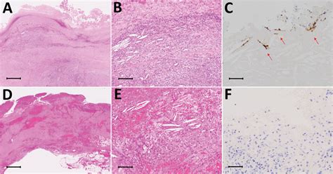 Figure 2 Determining Infected Aortic Aneurysm Treatment Using Focused