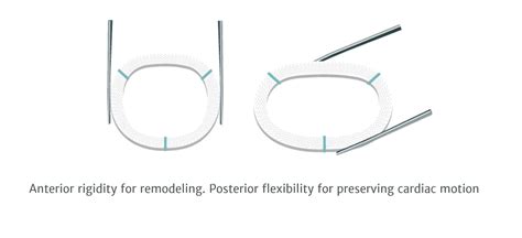 Carpentier Edwards Physio Ii Annuloplasty Ring Edwards Lifesciences Llc