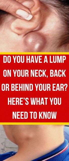 Do You May Have A Lump On Your Neck Back Or Behind Your Ear This Can