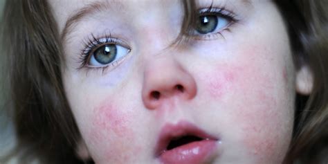 Red Rashes Around Eyes Pictures Photos