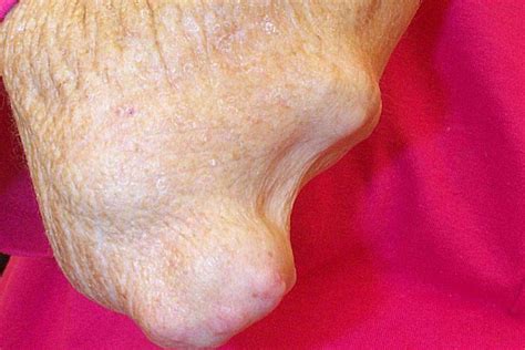 Rheumatoid Nodules Causes Diagnosis Pictures And More