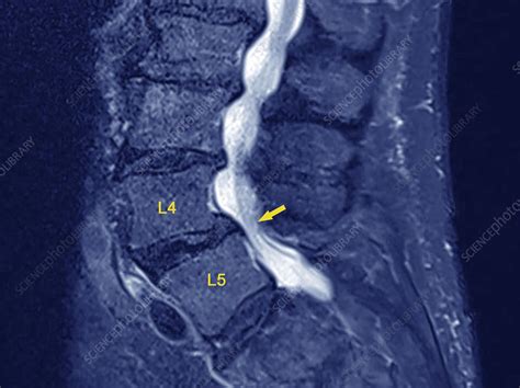 Spine In Spondylolisthesis Mri Scan Stock Image C0402323