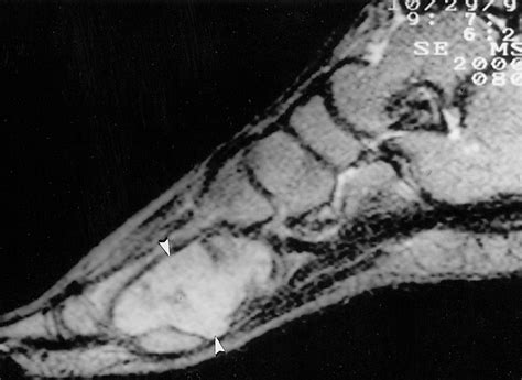 Imaging Of Musculoskeletal Fibromatosis Radiographics