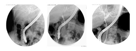 Rendezvous Techniques With Endoscopic Stenting For Common Bile Duct