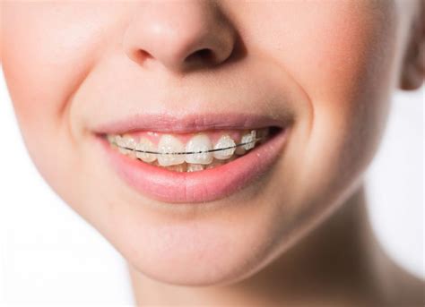 What Is Malocclusion Facty Health