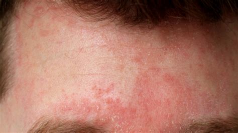 Eksem Seborroisk Dermatit Mjälleksem Praktisk Medicin