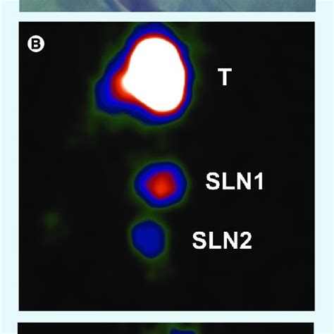 Sentinel Lymph Node Identification Using Lymphoscintigraphy And