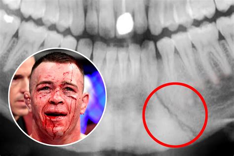 Loud Mouthed Colby Covington Shows Off X Ray Of Brutally Broken Jaw