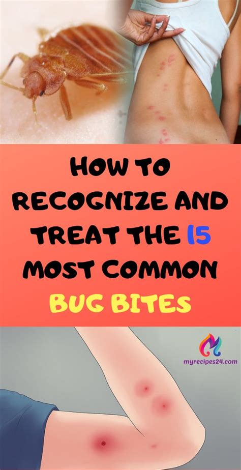 How To Recognize And Treat The Most Common Bug Bites My Recipes Bug Bites Health Tips