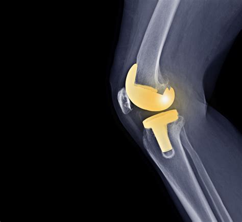 Outpatient Hip And Knee Replacement Q And A With Dr Justin W Langan