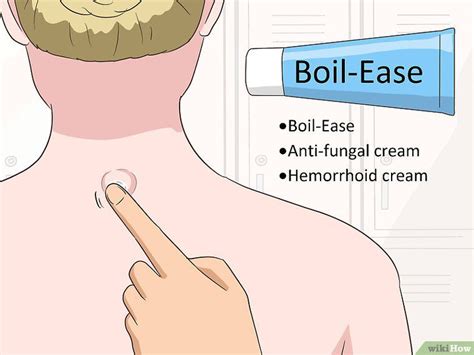 How To Remove A Cyst On Your Back How To Remove Cysts Home Remedies For Cysts