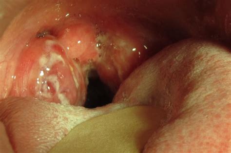 Is It Strep Throat Pictures And Symptoms