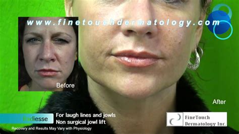 Nonsurgical Jowl Lift With Radiesse Before And After Facial