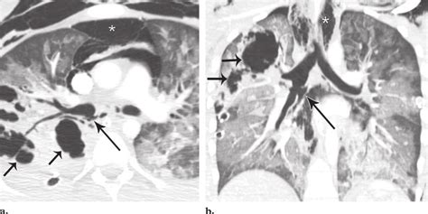 Bronchial Laceration Axial A And Coronal Reformatted B Ct Images