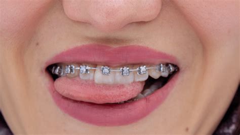 How Long Do I Have To Wear Braces Dr Bob Bryan Orthodontics