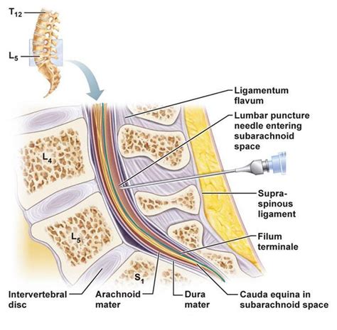 Lumbar Puncture Oxford Medical Education