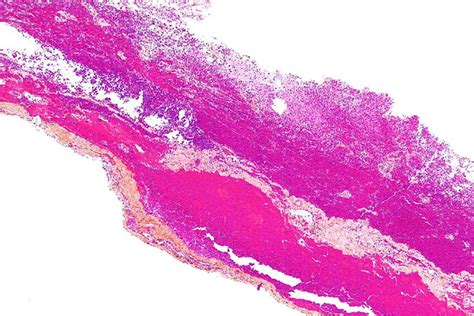 Hematoma Subdural Visto Con Microscopia Ptica Donde Se Puede Observar Download Scientific