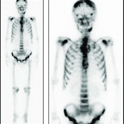 Skeletal Scintigraphy Indicated A Metabolic Active Lesion In The Bones