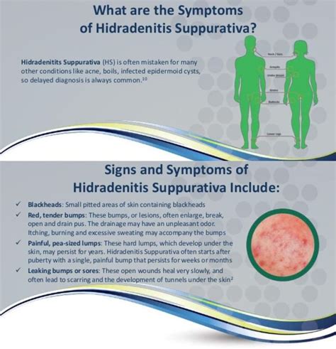 Pin On Hidradenitis Suppurativa