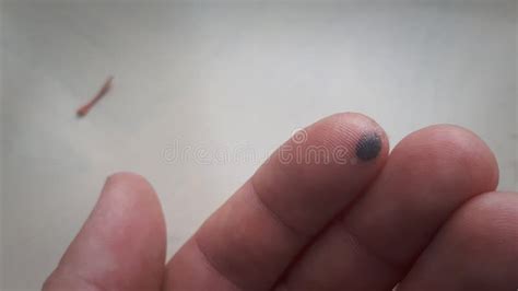 Hematoma On A Finger After Being Hit With A Hammer Stock Photo Image