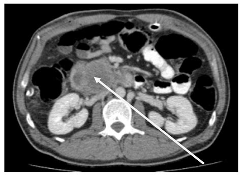 Primary Sarcoma Of The Pancreas A Rare Histopathological