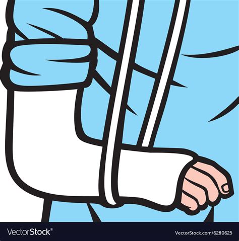 Broken Arm In A Cast Royalty Free Vector Image