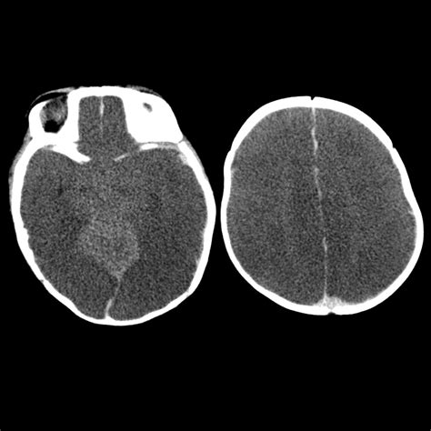 Causes Of Diffuse Cerebral Edema