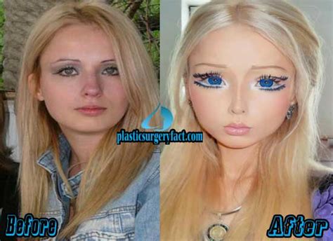 Barbie Woman Plastic Surgery Before And After Photos Plastic Surgery