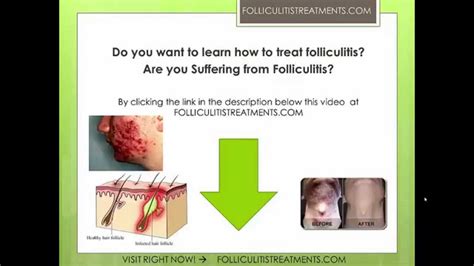 How To Treat Folliculitis And Get Rid Of Folliculitis Youtube