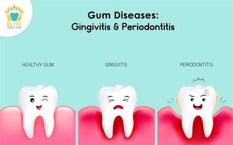 Gum Diseases Gingivitis And Periodontitis Elite Dental Care