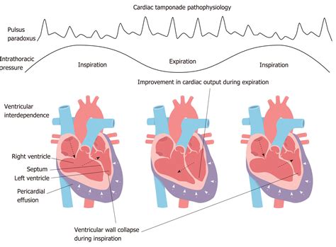 Pericarditis Pericardial Effusion Cardiac Tamponade B