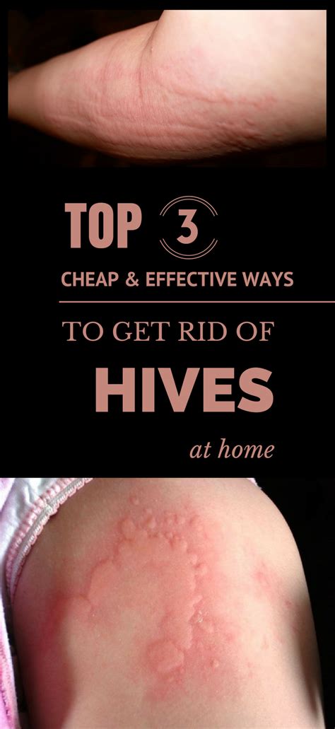 Top 3 Cheap And Effective Ways To Get Rid Of Hives At Home Hives Hives