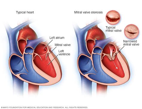 Typical Heart And Heart With Mitral Valve Stenosis Mayo Clinic