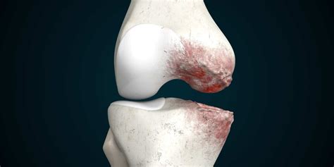 Knee Osteoarthritis Are You Feeling The Effects Of Wear And Tear