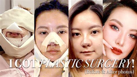 Amazeball Korean Plastic Surgery Before After Korean