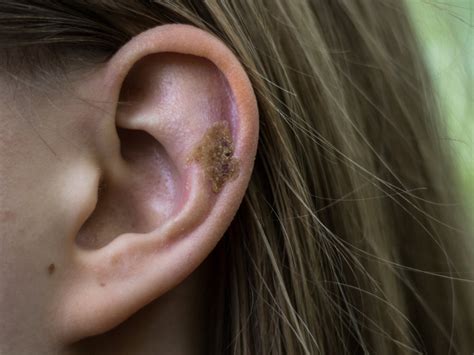 what causes scabs in my ear balmonds