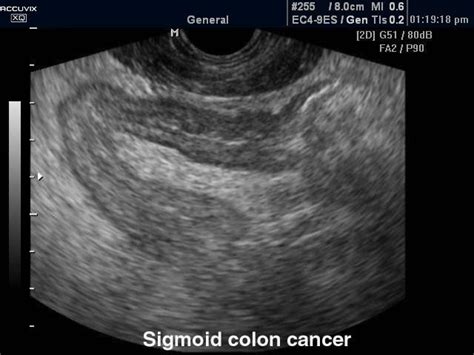 Ultrasound Images Sigmoid Colon Cancer B Mode Echogramm №385