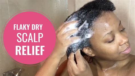 How To Cure A Dry Itchy Flaky Scalp Youtube