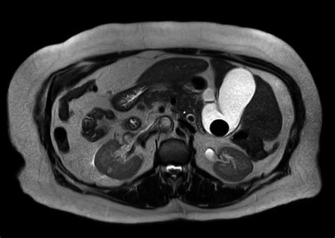 Axial T2‐weighted Mrcp Showing Gallbladder And Common Bile Duct Stones
