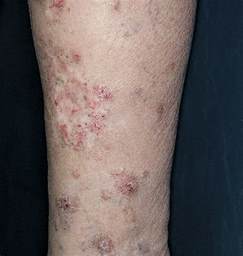 Verrucous Plaques On The Leg—diagnosis Dermatology Jama Dermatology