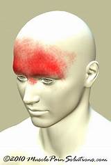 Frontal Headache Treatment Pictures