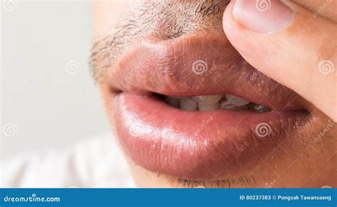 Closeup Of Lips Man Problem Health Care Herpes Simplex Stock Image