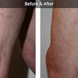 Vein Treatment New York Pictures
