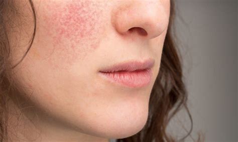 Eczema On Face Best Doctor For Homeopathy Treatment To Cure