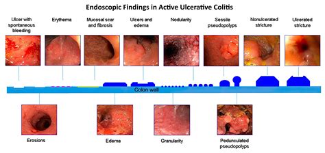 Endoscopic Findings In Active Ulcerative Colitis • Grepmed