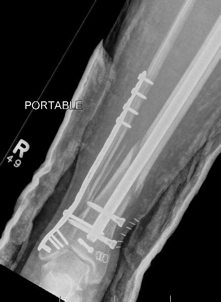 Distal Tibial Fractures The Bone Babe